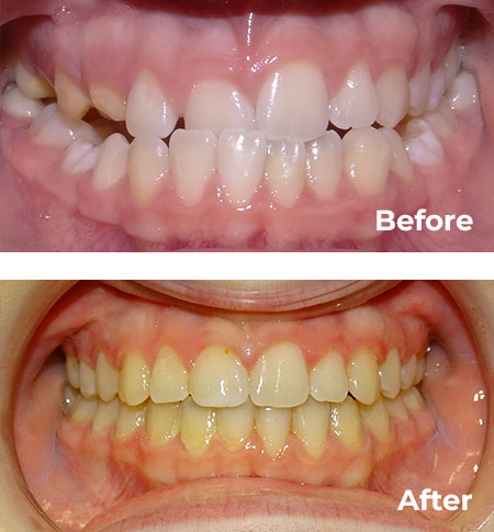 Kimberly Bonk's Smile Before and After