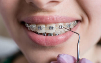 Orthodontic Myth Buster