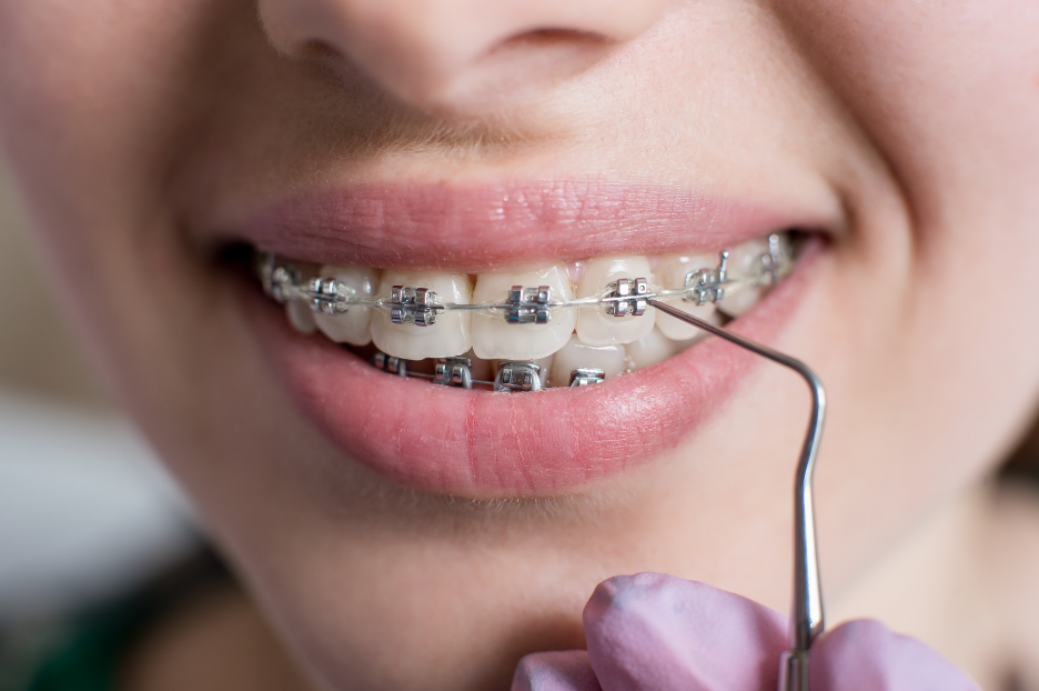 Orthodontic Myth Buster