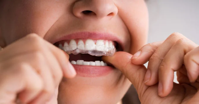 Why Clear Aligners Aren't For Everyone