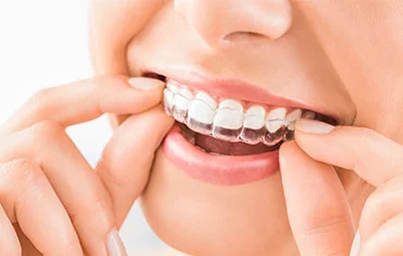 Invisalign and Other Clear Aligners