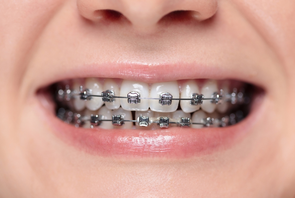 Is There a Way to Speed up My Treatment with Braces?